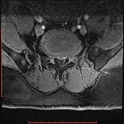 Non Hodgkin's lymphoma with metastasis to spine (Radiopaedia 54844-61103 Axial T1 C+ fat sat 15).jpg