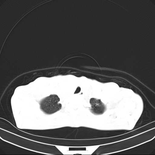 File:Non hodgkin lymphoma of the mediastinum (Radiopaedia 20814-20729 Axial lung window 7).jpg