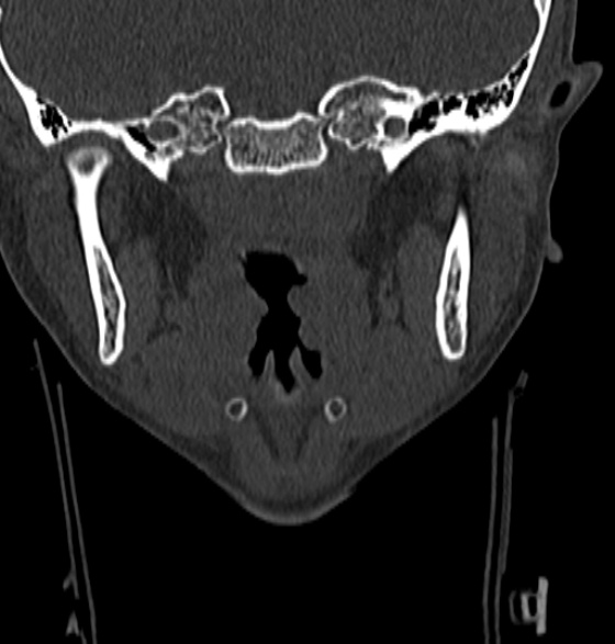 File:Normal CT cervical spine - 12-year-old (Radiopaedia 55352-61775 Coronal bone window 1).jpg