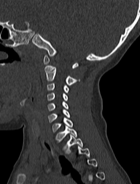 Normal CT cervical spine - pediatric (Radiopaedia 52549-58462 Sagittal bone window 143).jpg