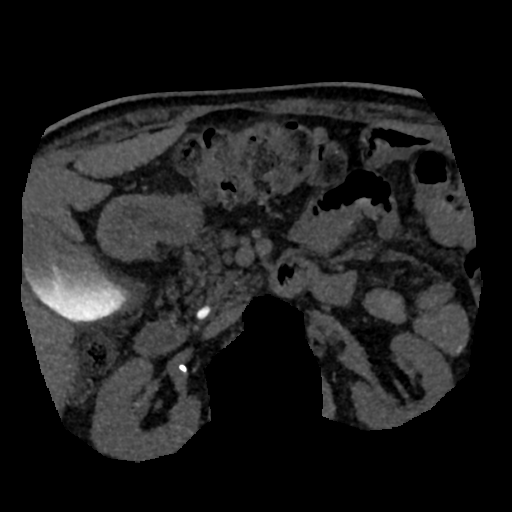File:Normal CT intravenous cholangiogram (Radiopaedia 38199-40208 Axial IVC (MIP) 24).png