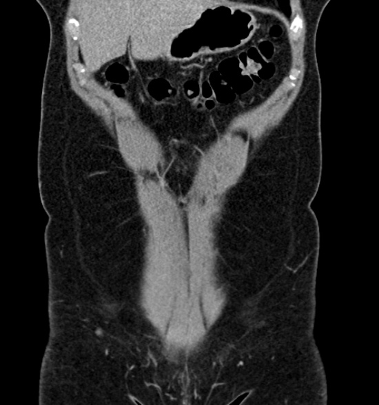 File:Normal CT intravenous urogram (Radiopaedia 39444-41759 A 187).jpg