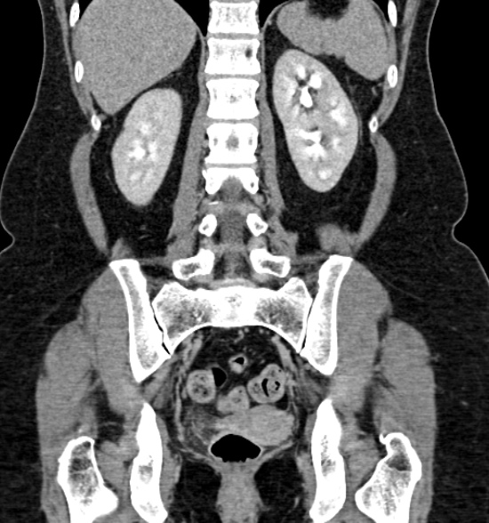 Normal CT intravenous urogram (Radiopaedia 39444-41759 A 321).jpg
