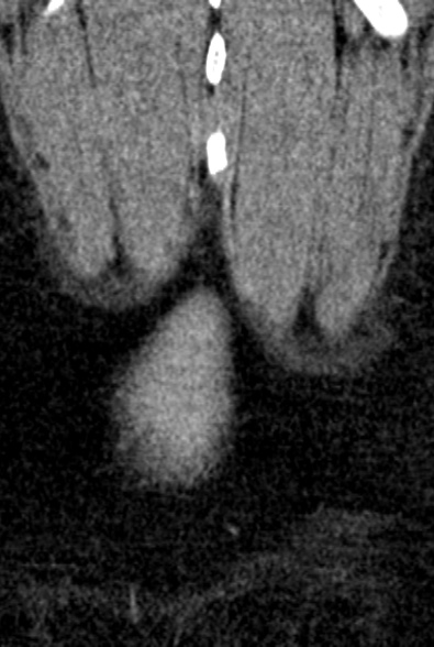 Normal CT lumbar spine (Radiopaedia 53981-60118 F 105).jpg