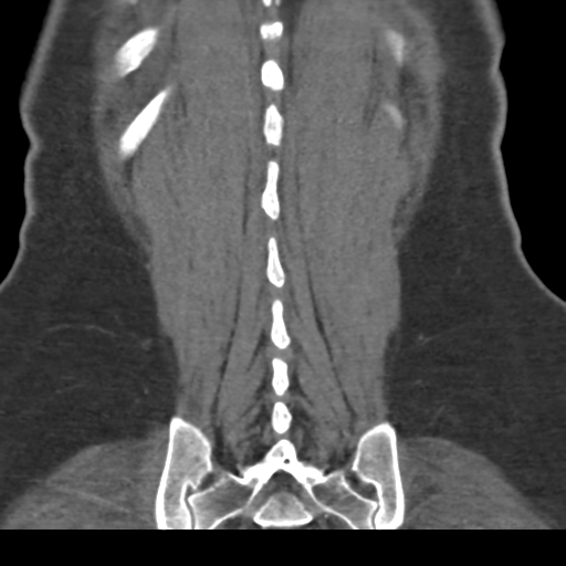 File:Normal CT renal artery angiogram (Radiopaedia 38727-40889 B 68).png