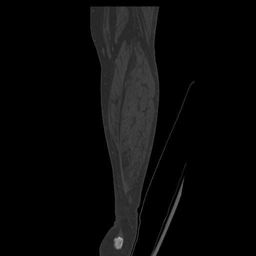 Normal CT tibia and fibula (Radiopaedia 51195-56848 Coronal non-contrast 58).jpg
