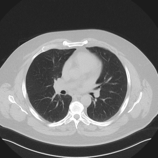Normal HRCT (Radiopaedia 40797-43458 Axial lung window 29).png