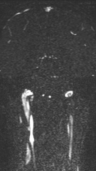 Normal MRI brain with MRV- teenager (Radiopaedia 49425-54553 Coronal MRV 152).jpg