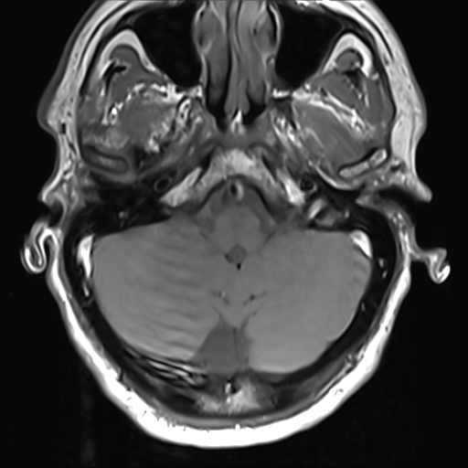 File:Normal MRI cervical spine (infection protocol) (Radiopaedia 53916-60039 Axial 2).png