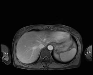 Normal adrenal glands MRI (Radiopaedia 82017-96004 M 15).jpg