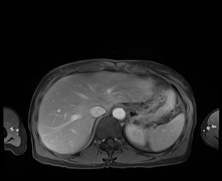 Normal adrenal glands MRI (Radiopaedia 82017-96004 M 18).jpg