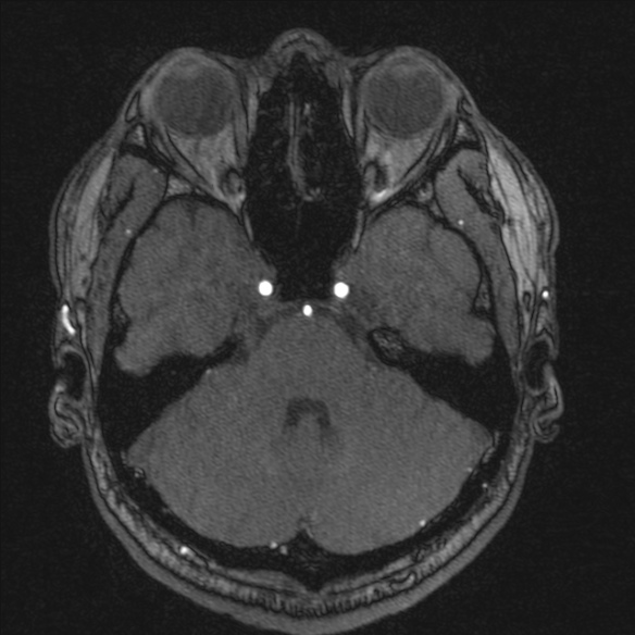 Normal brain MRI including MRA (Radiopaedia 48748-53763 Axial MRA 54).jpg