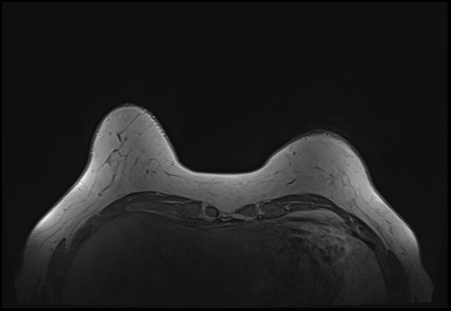 File:Normal breast MRI - dense breasts (Radiopaedia 80454-93850 Axial T1 39).jpg