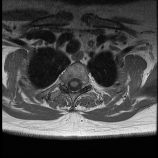 File:Normal cervical and thoracic spine MRI (Radiopaedia 35630-37156 Axial T1 3).png