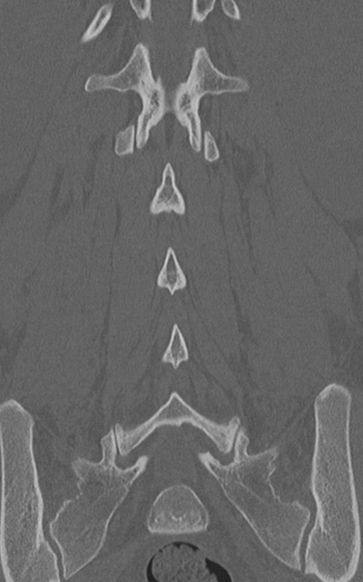 Normal lumbar spine CT (Radiopaedia 46533-50986 Coronal bone window 53).png