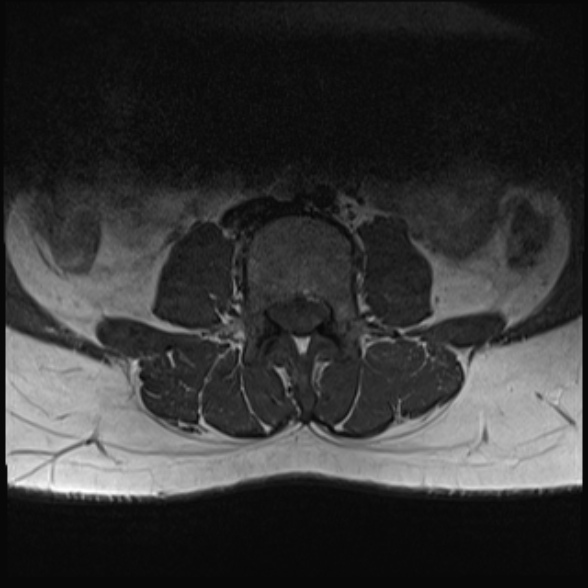 File:Normal lumbar spine MRI- 3 T (Radiopaedia 53280-59250 Axial 12).jpg