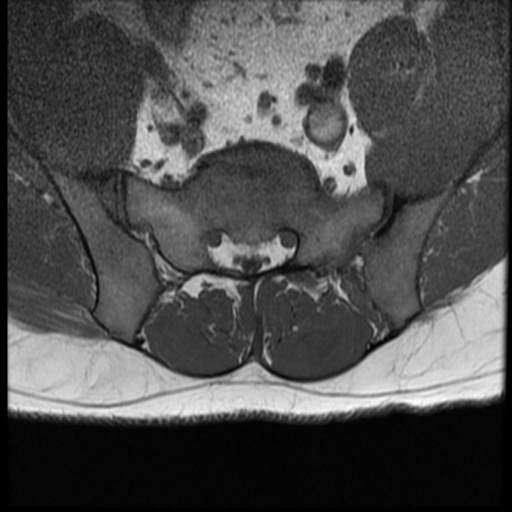 File:Normal lumbar spine MRI (Radiopaedia 35543-37039 Axial T1 4).png