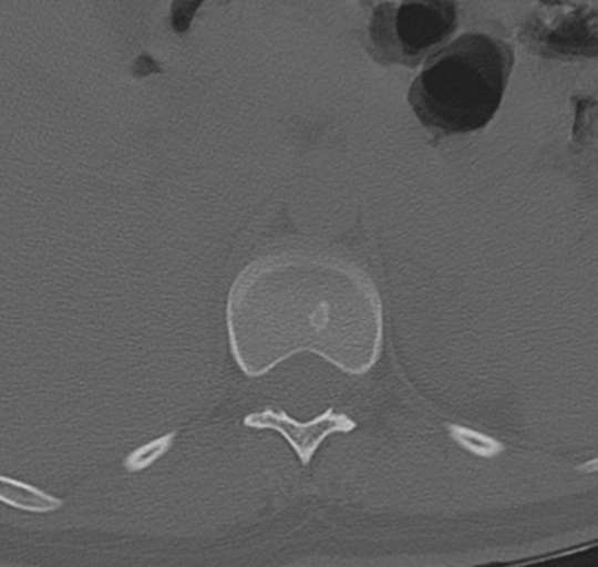 File:Normal lumbosacral CT (Radiopaedia 37923-39867 Axial bone window 14).png