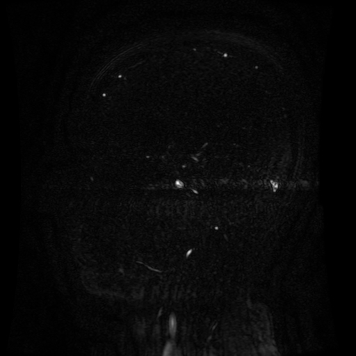 Normal noncontrast MR venography (Radiopaedia 87578-103957 A 63).jpg