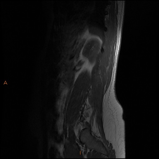 File:Normal spine MRI (Radiopaedia 77323-89408 Sagittal T1 13).jpg
