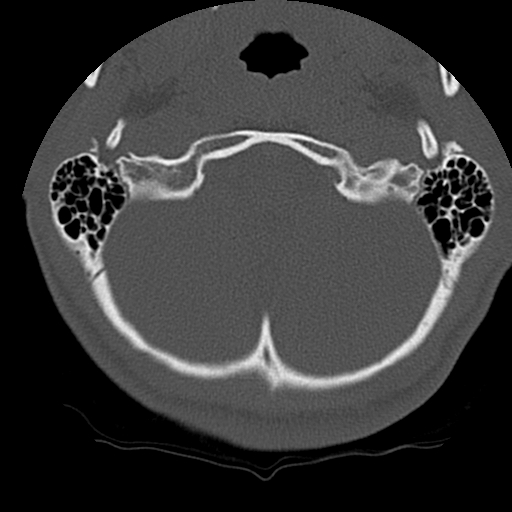 Normal trauma spine imaging (age 16) (Radiopaedia 45335-49358 Axial bone window 1).jpg