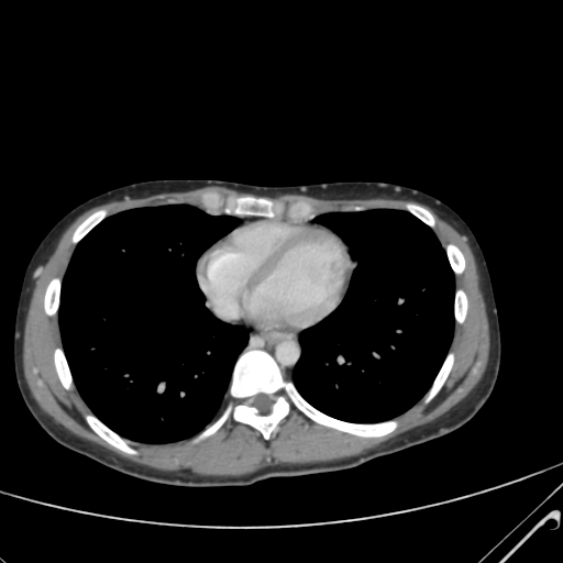 File:Nutmeg liver- Budd-Chiari syndrome (Radiopaedia 46234-50635 B 1).png