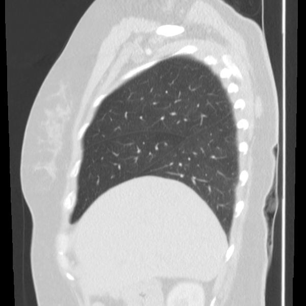 Obstructing typical carcinoid causing bronchoceles (Radiopaedia 50149-55476 Sagittal lung window 13).png
