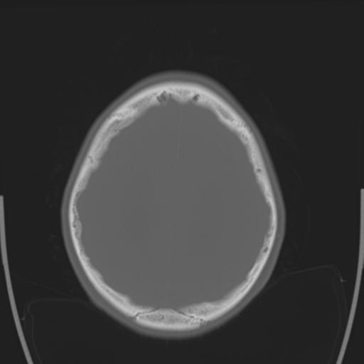 File:Obstructive hydrocephalus (Radiopaedia 30453-31119 Axial bone window 8).jpg