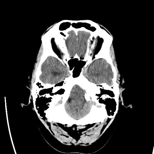 File:Obstructive hydrocephalus (Radiopaedia 30453-31119 Axial non-contrast 5).jpg