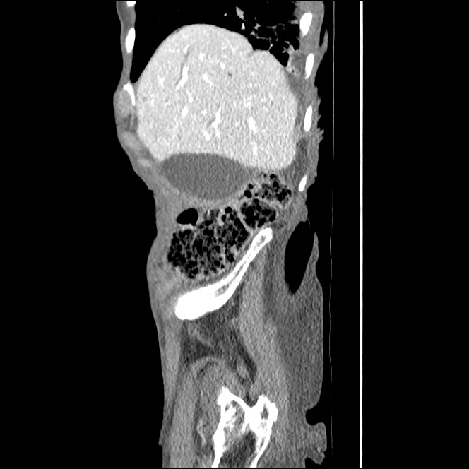 Obturator hernia causing small bowel obstruction (Radiopaedia 65522-74612 C 83).jpg