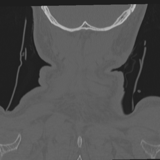 File:Occipital condyle fracture (Radiopaedia 33467-34517 Coronal bone window 70).png