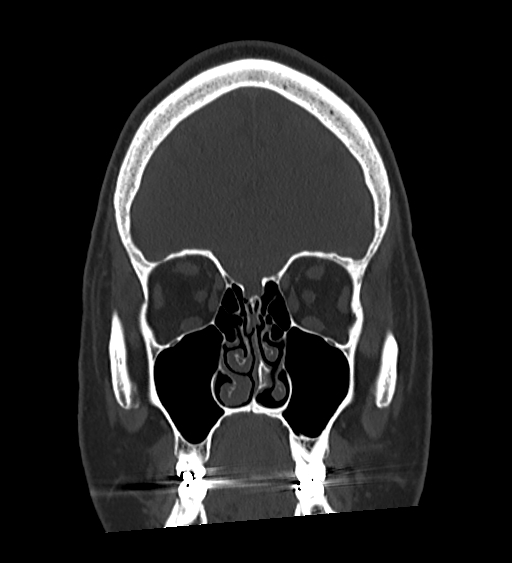 Occipital spur and Currarino type A atlas anomaly (Radiopaedia 87027-103285 Coronal bone window 47).jpg