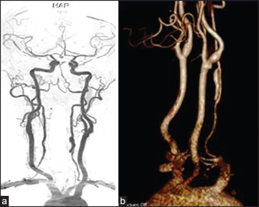 Vertebral artery dissection with focal dilatation of involved segment