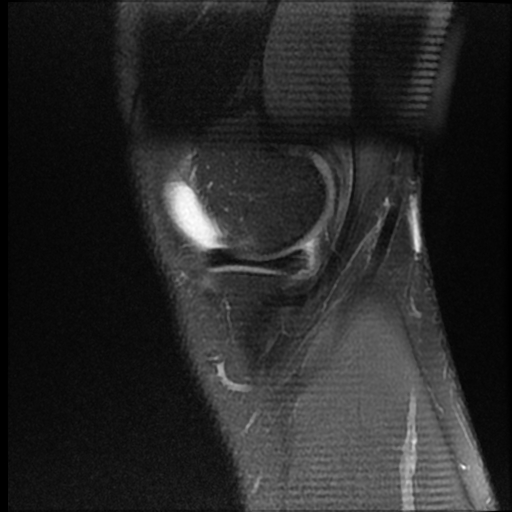 File:ACL acute full thickness tear - deep lateral femoral sulcus sign (Radiopaedia 38594-40740 Sagittal PD fat sat 3).jpg