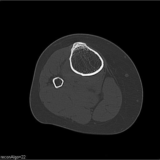 File:ACL avulsion fracture (Radiopaedia 33833-34994 Axial bone window 26).jpg