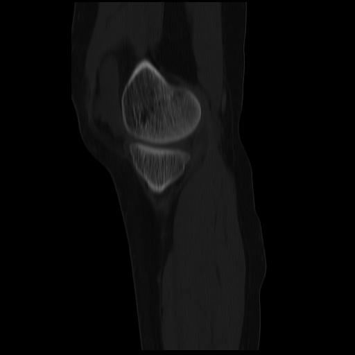 File:ACL avulsion fracture (Radiopaedia 33833-34994 Sagittal bone window 34).jpg