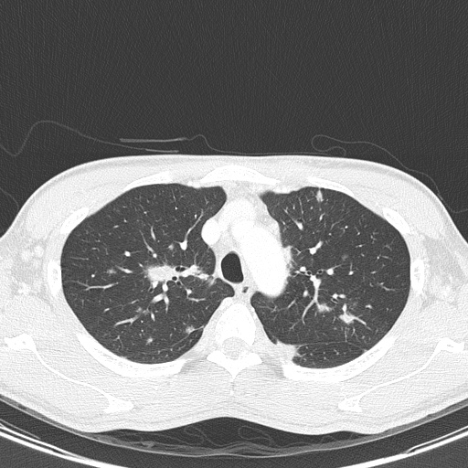 AIDS-related Kaposi sarcoma (Radiopaedia 85247-100811 Axial lung window 42).jpg