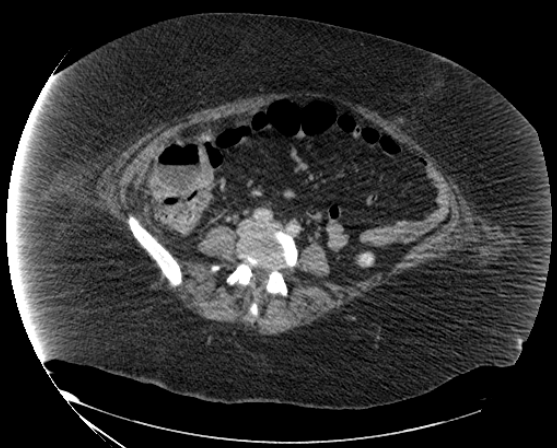File:Abdominal abscess - pre and post percutaneous drainage (Radiopaedia 60209-67816 Axial 44).png