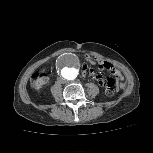 Abdominal aortic aneurysm (Radiopaedia 13341-13340 Axial C+ arterial phase 128).jpg