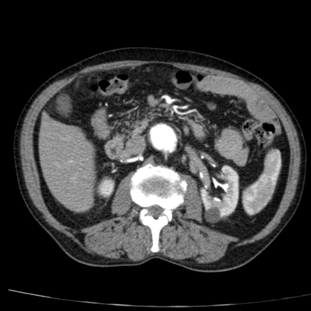 Abdominal aortic aneurysm (Radiopaedia 29248-29660 Axial C+ arterial phase 35).jpg