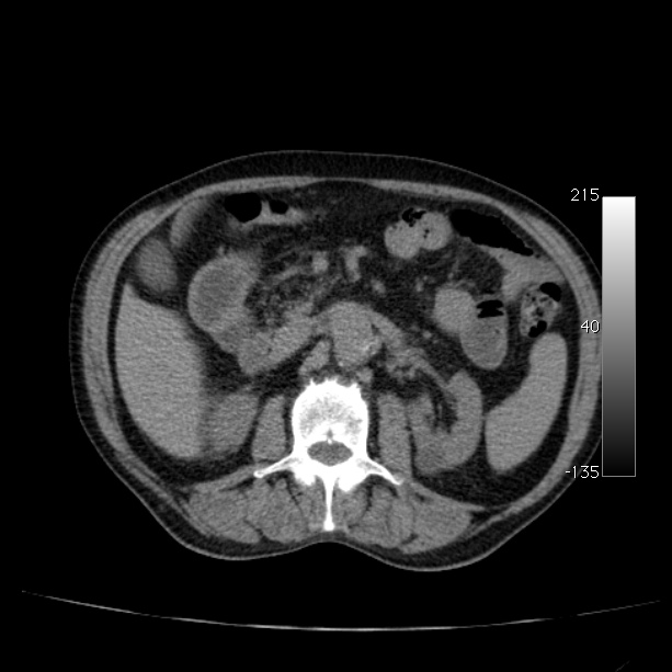 Abdominal aortic aneurysm (Radiopaedia 29248-29660 Axial non-contrast 23).jpg