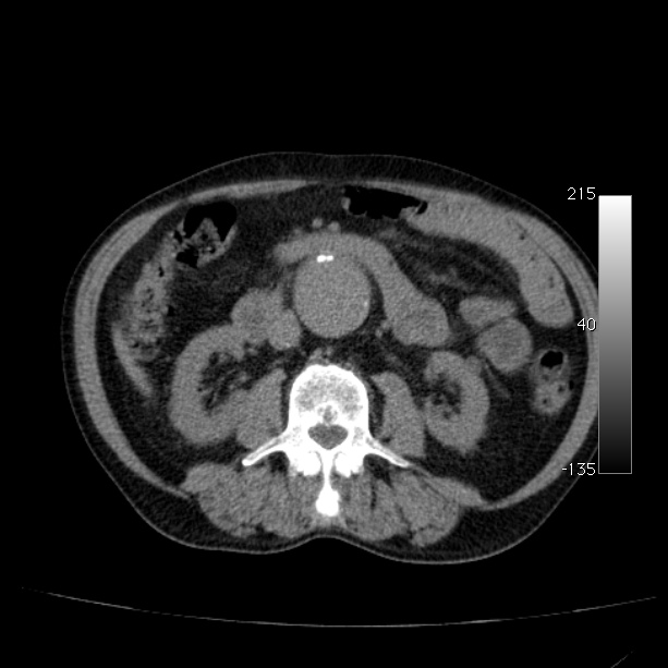 Abdominal aortic aneurysm (Radiopaedia 29248-29660 Axial non-contrast 27).jpg