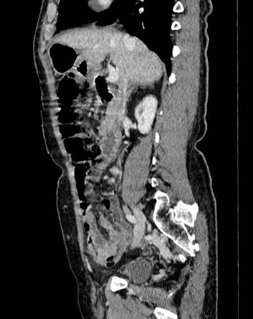 Abdominal aortic aneurysm (Radiopaedia 83581-98689 Sagittal C+ portal venous phase 20).jpg
