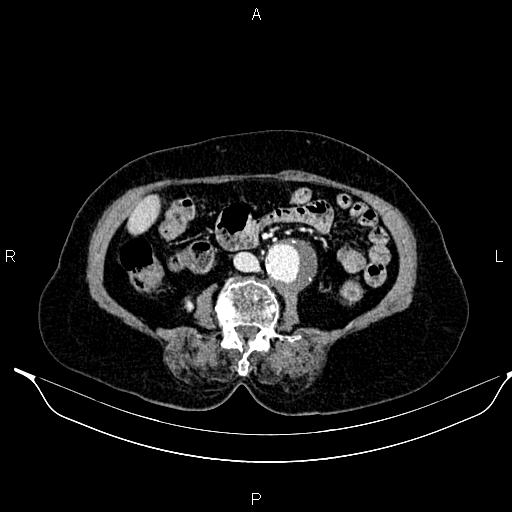File:Abdominal aortic aneurysm (Radiopaedia 85063-100606 Axial C+ portal venous phase 42).jpg