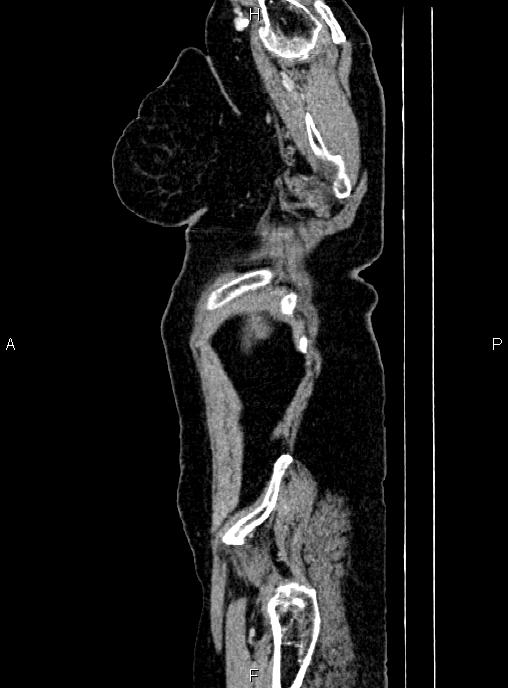 Abdominal aortic aneurysm (Radiopaedia 85063-100606 Sagittal C+ arterial phase 2).jpg