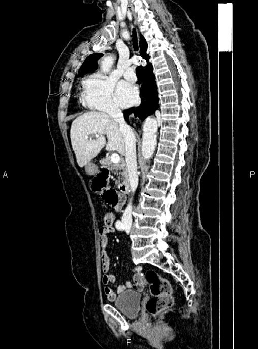 Abdominal aortic aneurysm (Radiopaedia 85063-100606 Sagittal C+ arterial phase 36).jpg