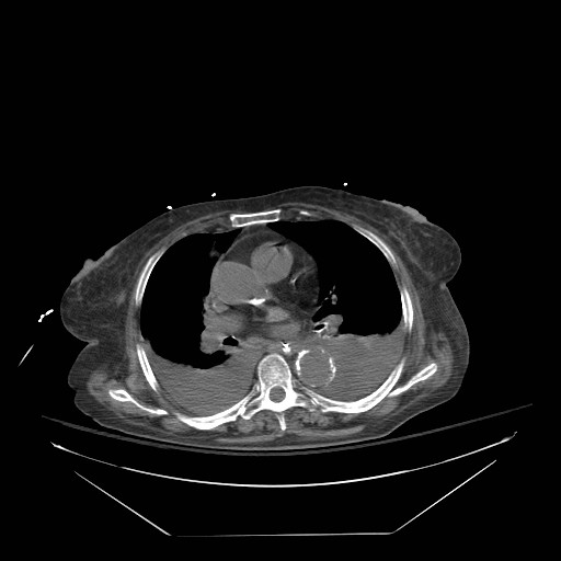 Abdominal aortic aneurysm - impending rupture (Radiopaedia 19233-19247 Axial non-contrast 2).jpg