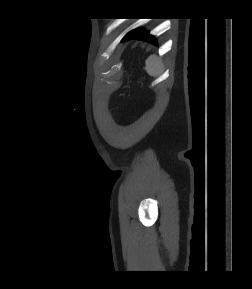 Abdominal aortic aneurysm with thrombus fissuration (Radiopaedia 46218-50618 Sagittal C+ arterial phase 56).jpg