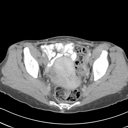 Abdominal desmoid tumor (Radiopaedia 41007-43740 Axial C+ portal venous phase 63).png