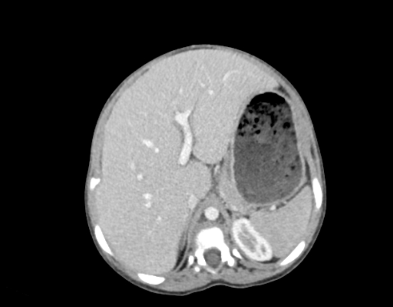 Abdominal premesenteric cystic lymphangioma (Radiopaedia 82995-97350 Axial C+ portal venous phase 12).jpg